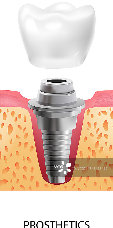 牙科植入修复组合图片素材