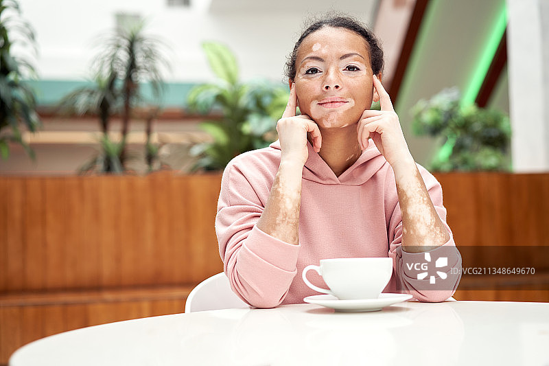 患有白癜风色素沉着皮肤的黑人妇女图片素材