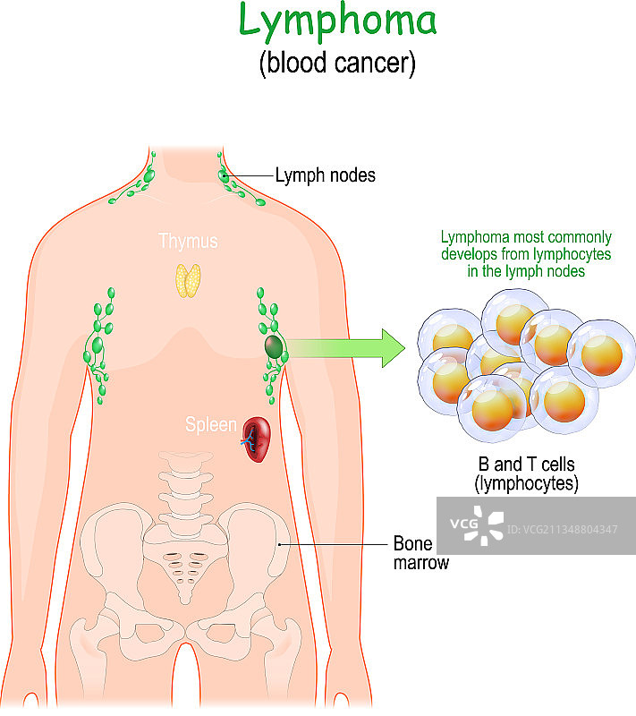 淋巴瘤或血癌图片素材