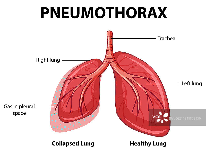 带肺部塌陷的气胸图图片素材