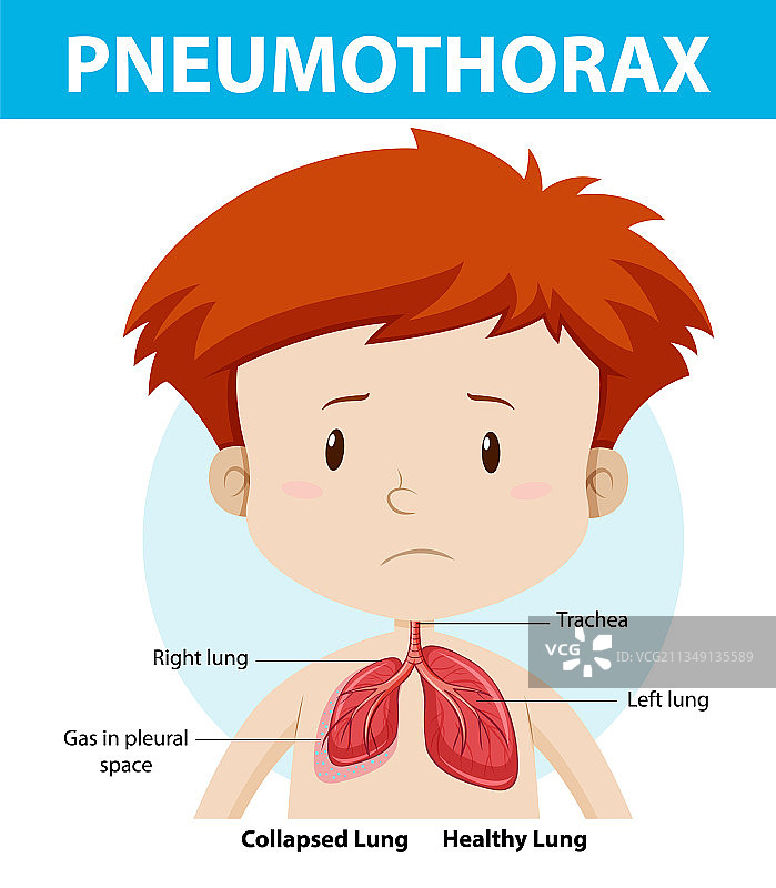 人体解剖气胸图图片素材