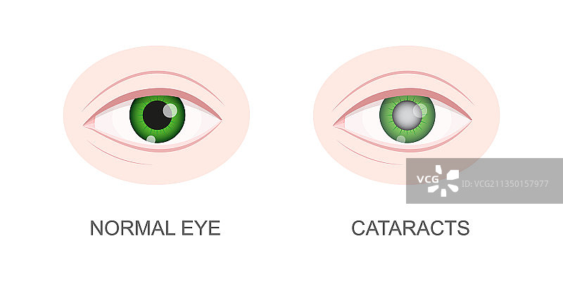 健康的眼睛与白内障眼部特写图片素材