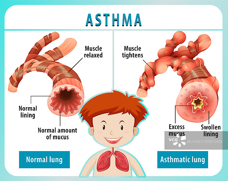 正常肺与哮喘肺的图表图片素材