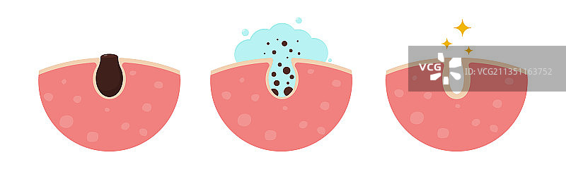 清洁堵塞毛孔肌肤图片素材