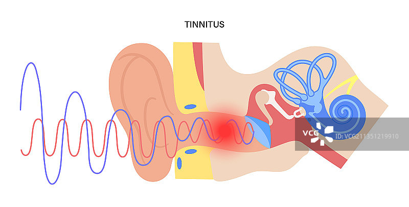 耳鸣疾病概念图片素材