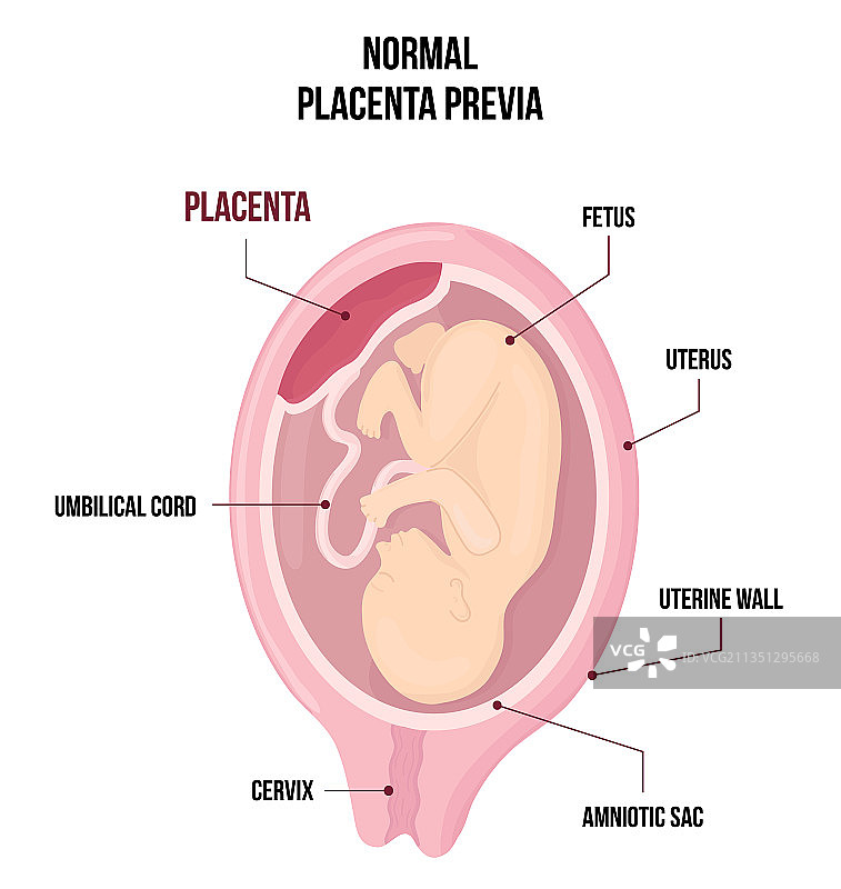 正常性前置胎盘解剖结构图片素材