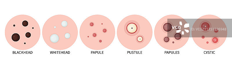 皮肤上的痤疮和粉刺类型图片素材