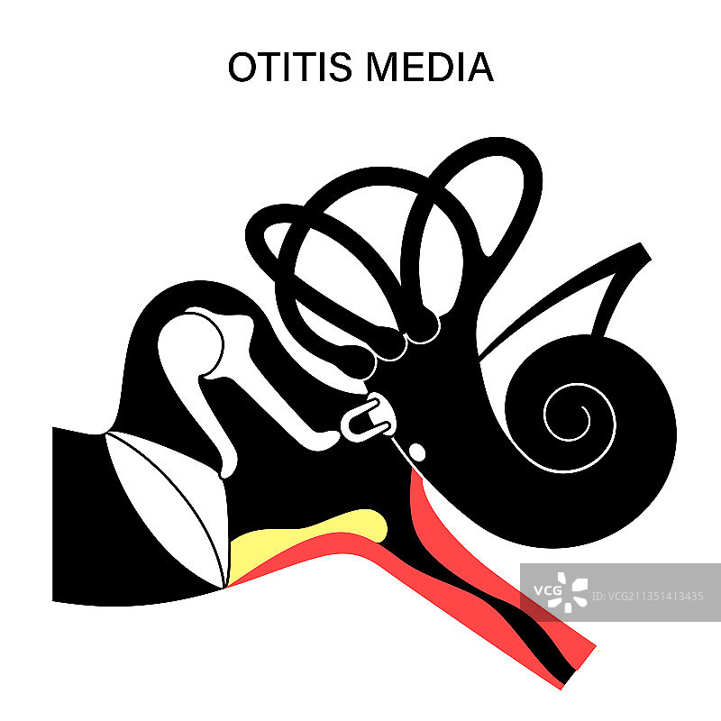 中耳炎疾病图片素材