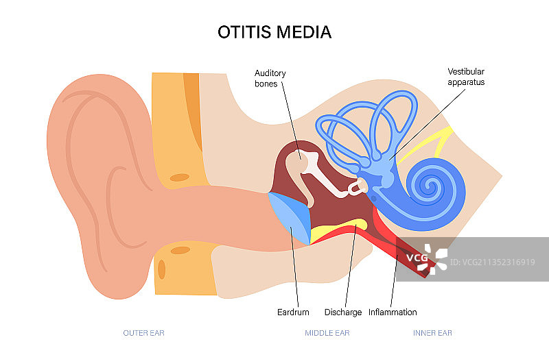 中耳炎疾病图片素材