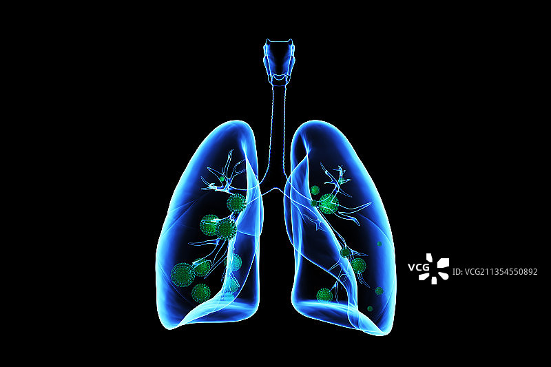 医学3D演示被新冠病毒感染的肺图片素材