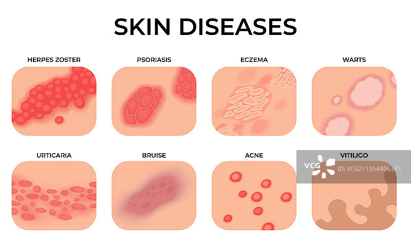 皮肤疾病：不同表皮疾病图片素材