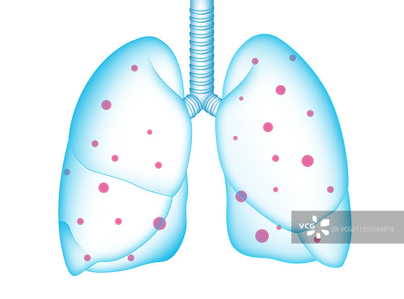 肺部感染插画图片素材