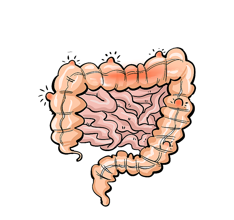 溃疡性大肠炎图片素材