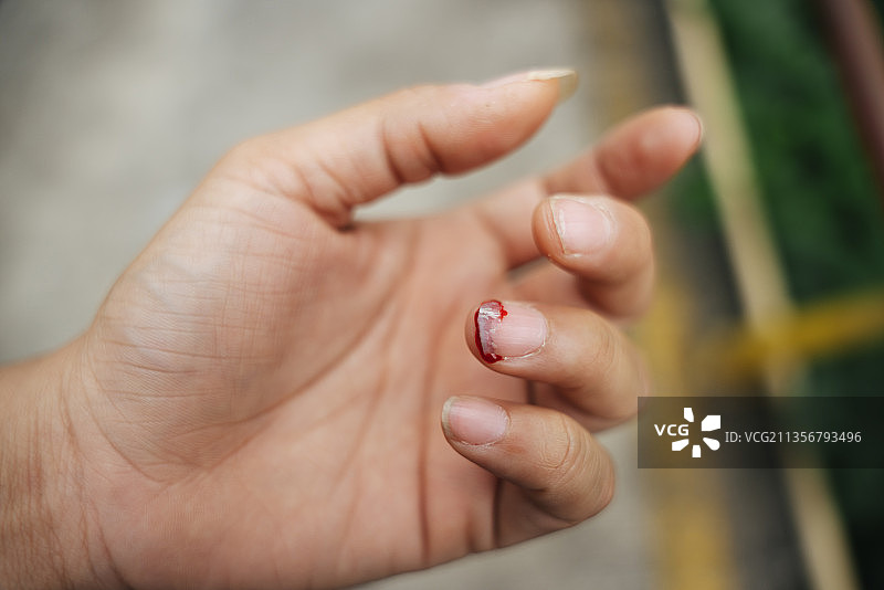 指甲周围皮肤撕裂出血。图片素材