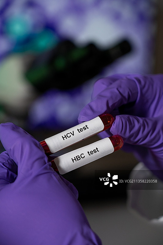 乙型肝炎（HBC）和丙型肝炎（HCV）的血液检查图片素材