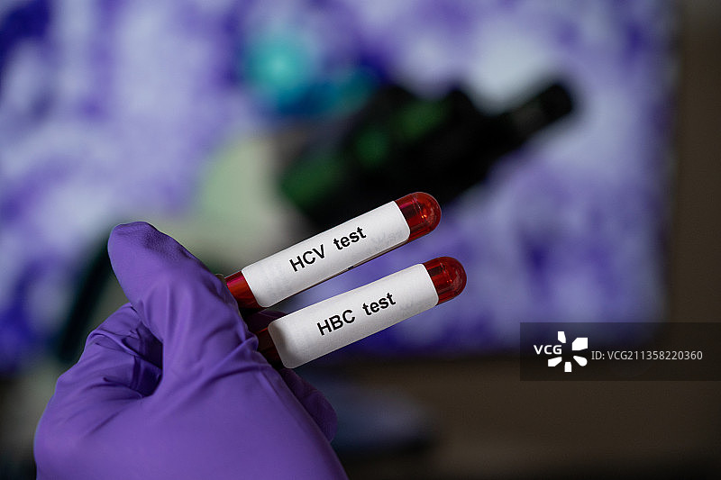 乙型肝炎（HBC）和丙型肝炎（HCV）的血液检查图片素材
