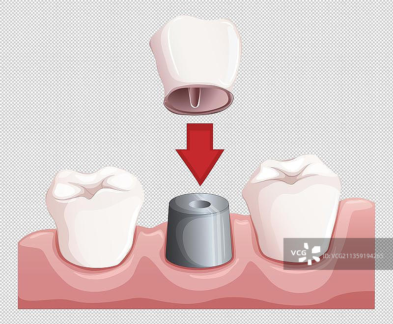 卡通正准备镶牙的背景图图片素材