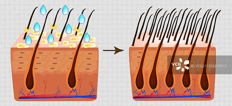 卡通肤色油脂头皮元素图片素材