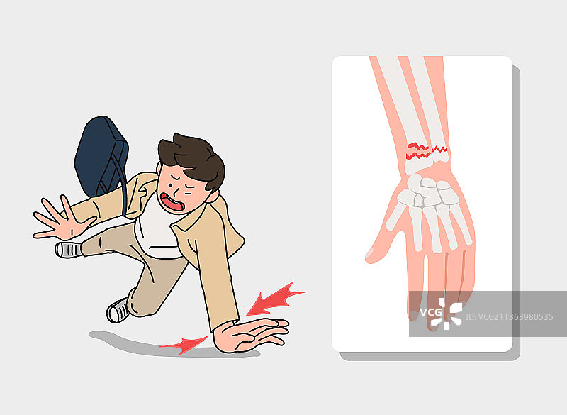 手腕骨折事故图片素材