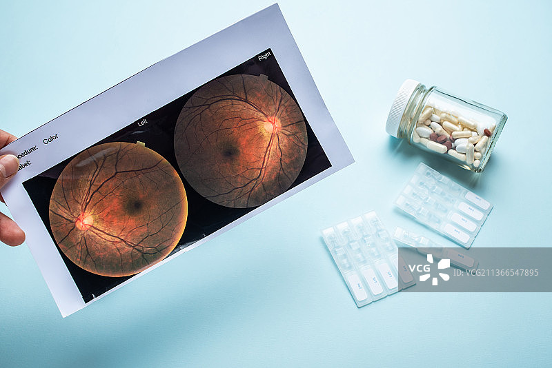 一张眼底彩照报告单和眼药水药丸图片素材