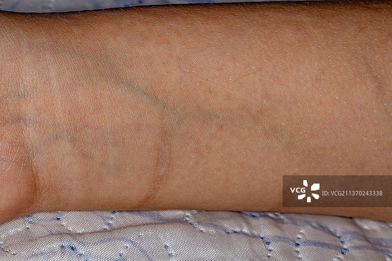 过敏红疹与人体脉搏图片素材