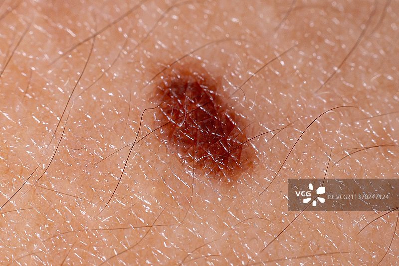 皮肤上的斑点，蜘蛛网上的蜘蛛特写图片素材