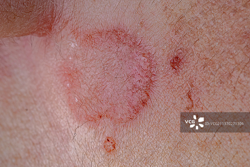 皮炎皮肤损伤，受伤的腿部特写图片素材