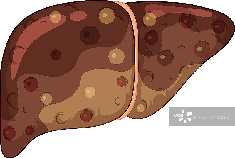 白色背景上的肝纤维化图片素材