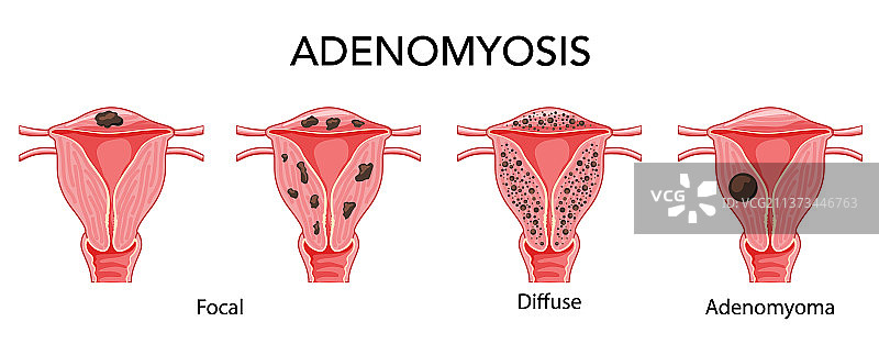 子宫腺肌症疾病套装 - 局灶性弥漫性图片素材