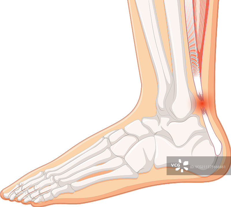 白色背景上的跟腱断裂图片素材
