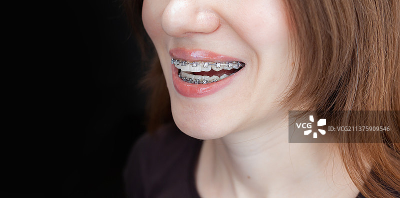 戴牙套的年轻女孩的微笑图片素材