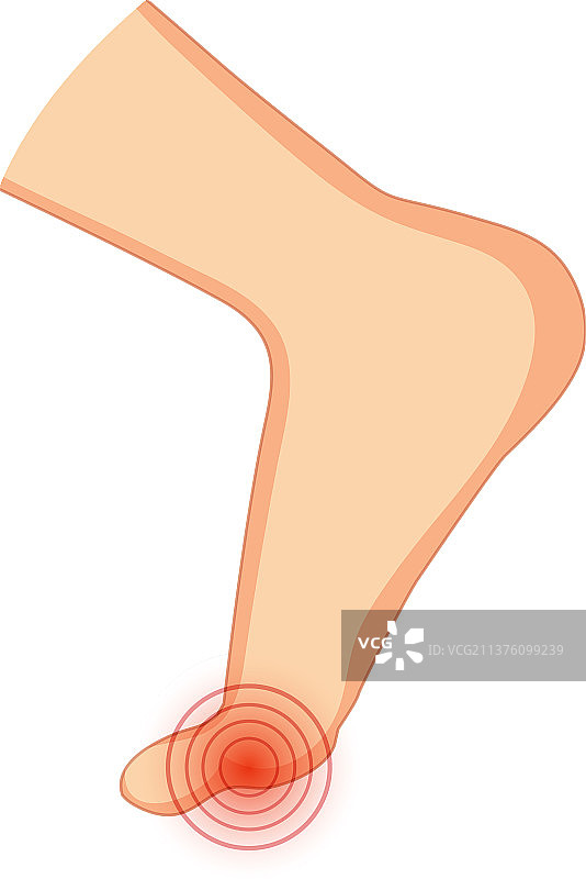 白色背景上的拇外翻类型图片素材