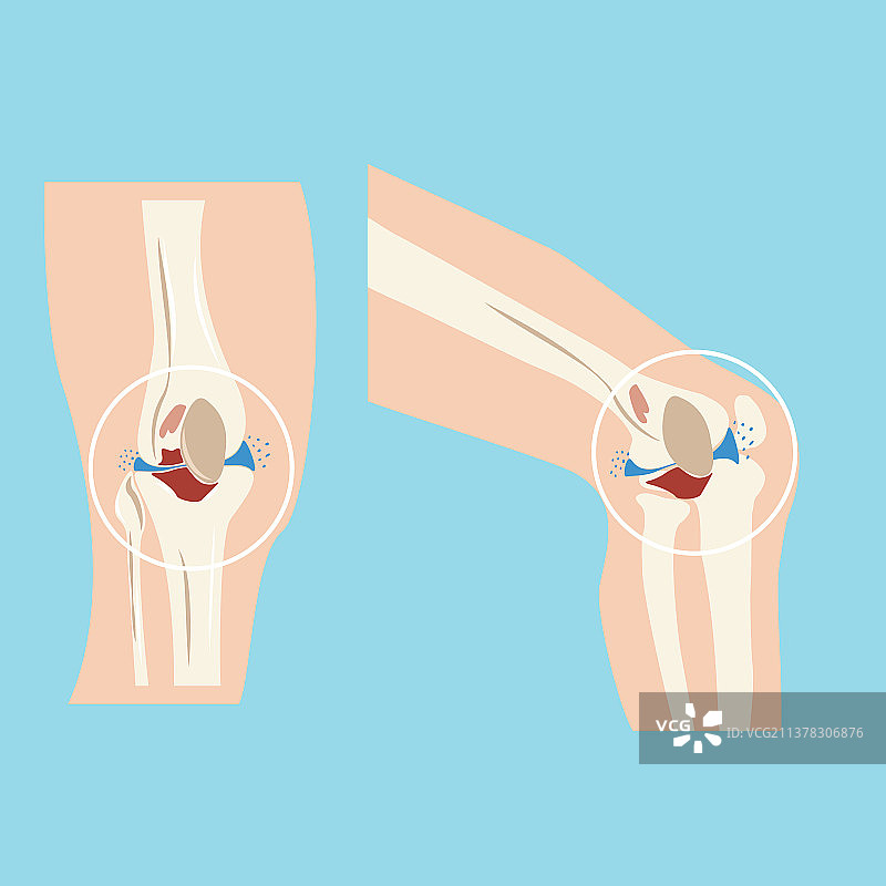 受损的人类膝关节设计图片素材