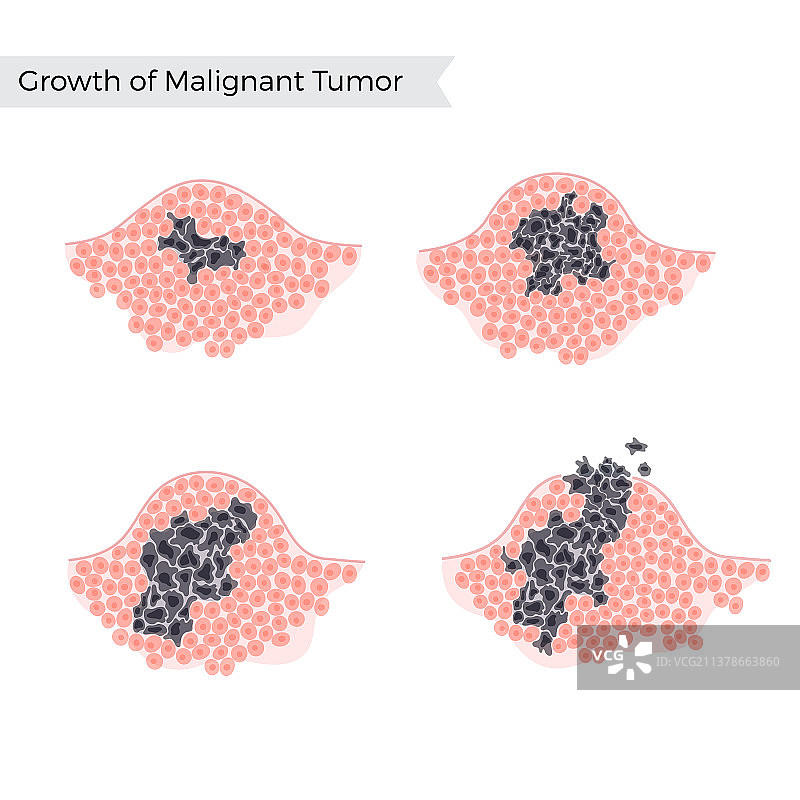 孤立的恶性肿瘤图片素材