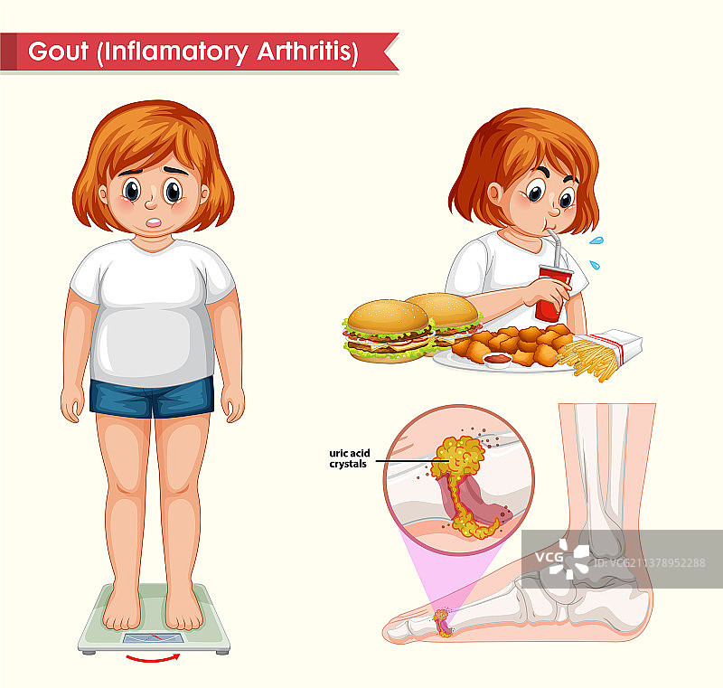 医学科学痛风性关节炎图片素材