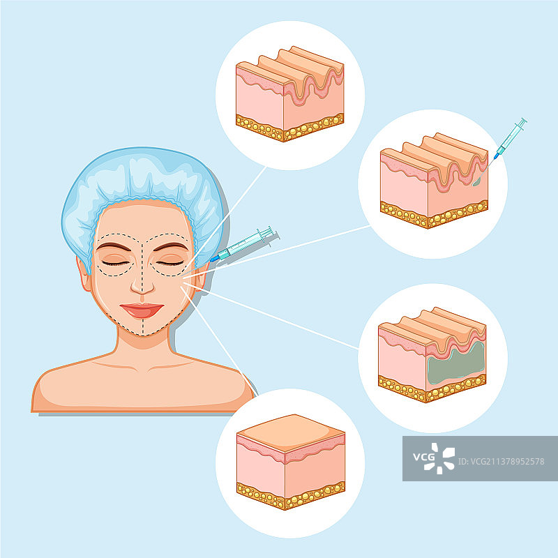 医学肉毒杆菌注射图片素材
