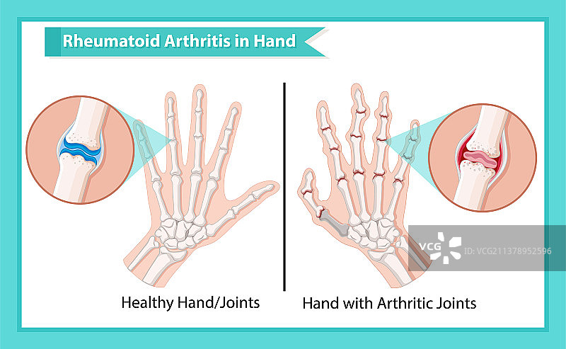 类风湿性关节炎医学研究图片素材