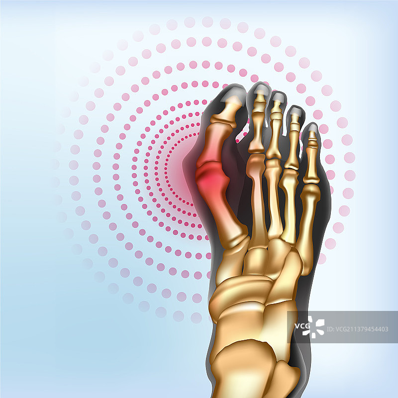 拇囊炎足部畸形真实骨骼图片素材