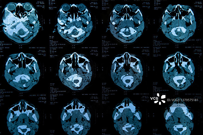 脑部CT扫描影像图片素材