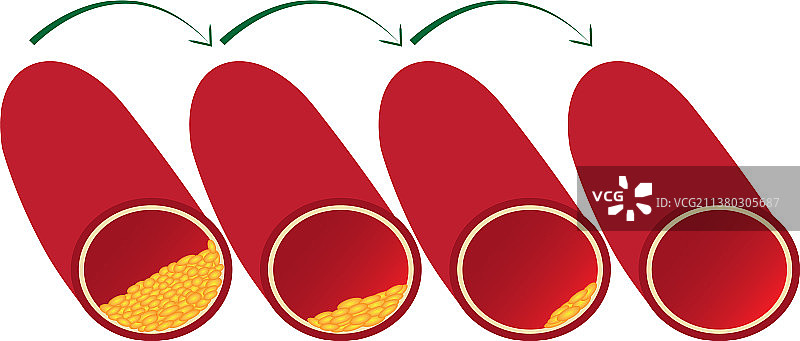 清理血管图片素材