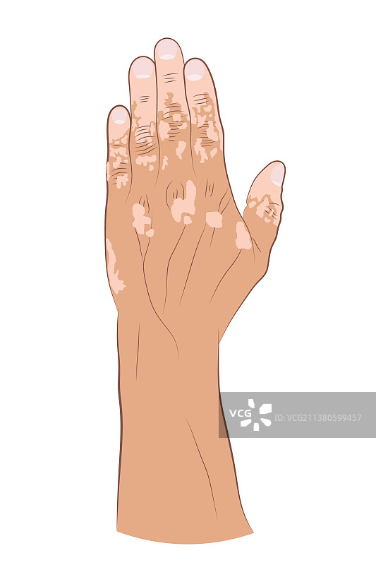 医学特效：白癜风图片素材