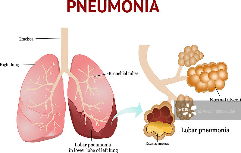 肺炎球菌性肺炎（白色背景）图片素材