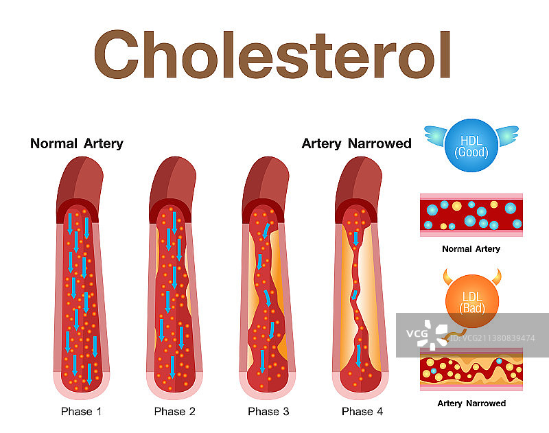 胆固醇在动脉健康风险设计中的应用图片素材
