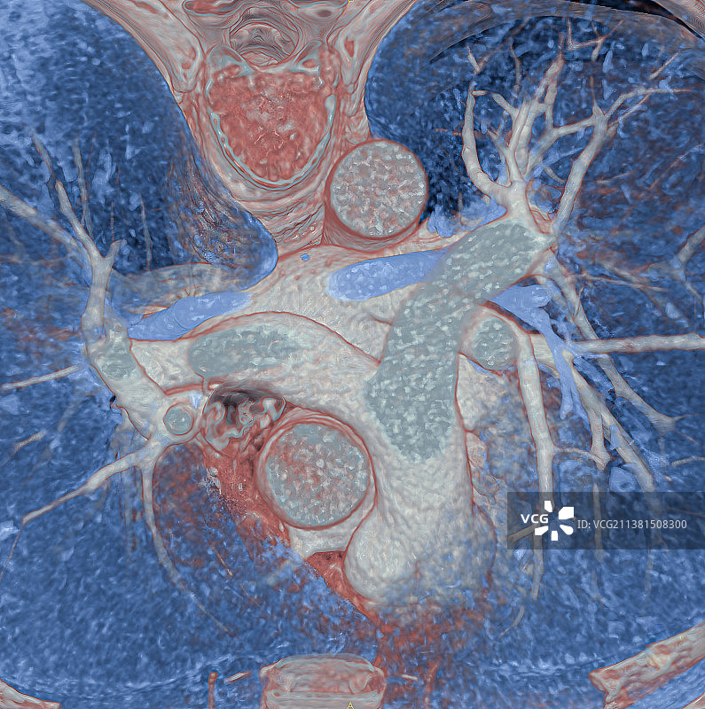 胸廓的3D CT扫描图片素材