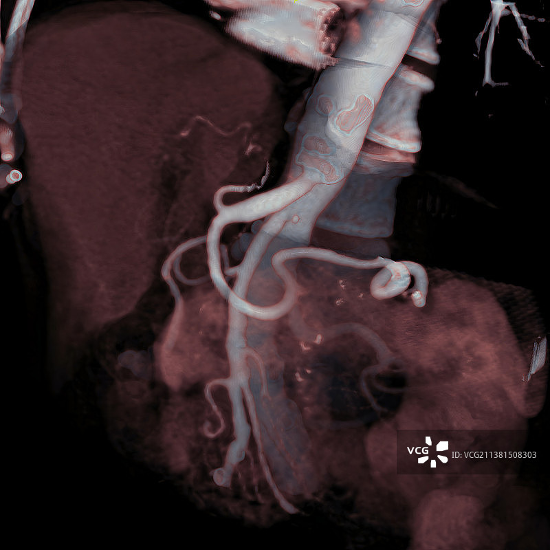 腹部3D CT扫描科学影像图片素材