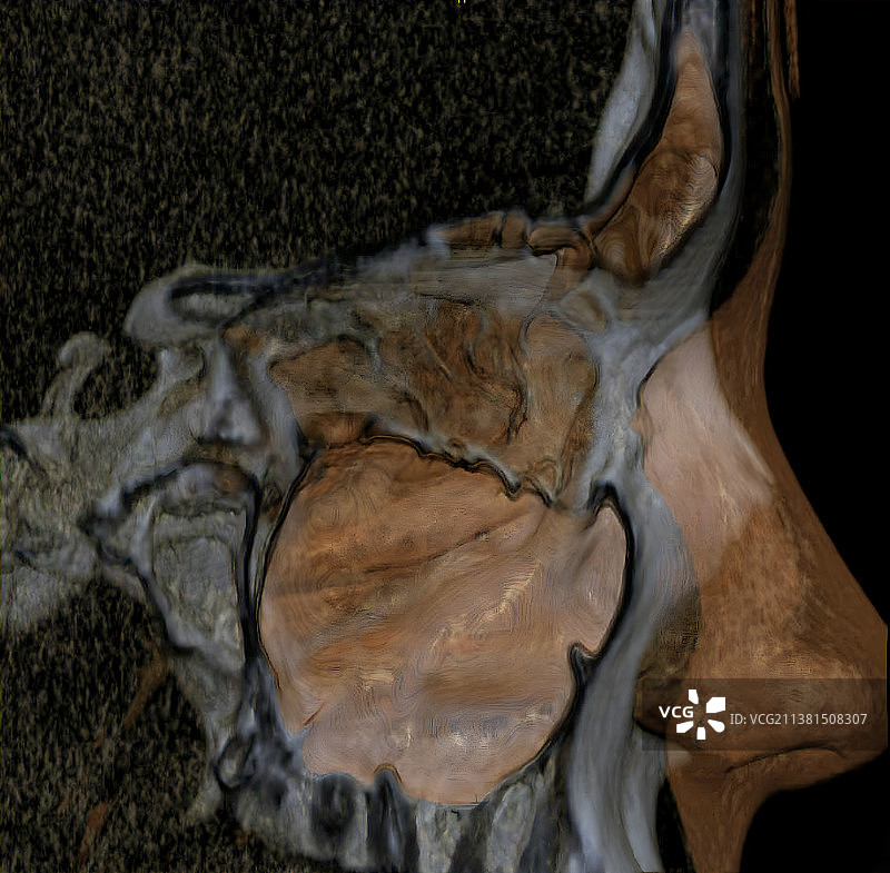 上颌窦和鼻骨的3D CT扫描侧面图图片素材