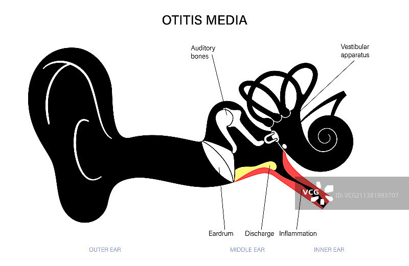 中耳炎疾病图片素材