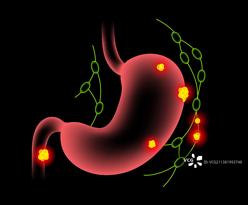 胃癌解剖结构图片素材