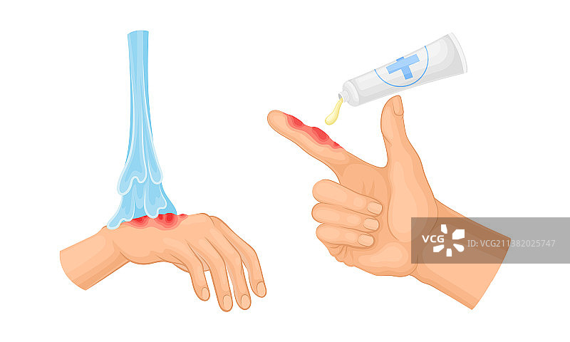 皮肤烧伤急救处理图片素材