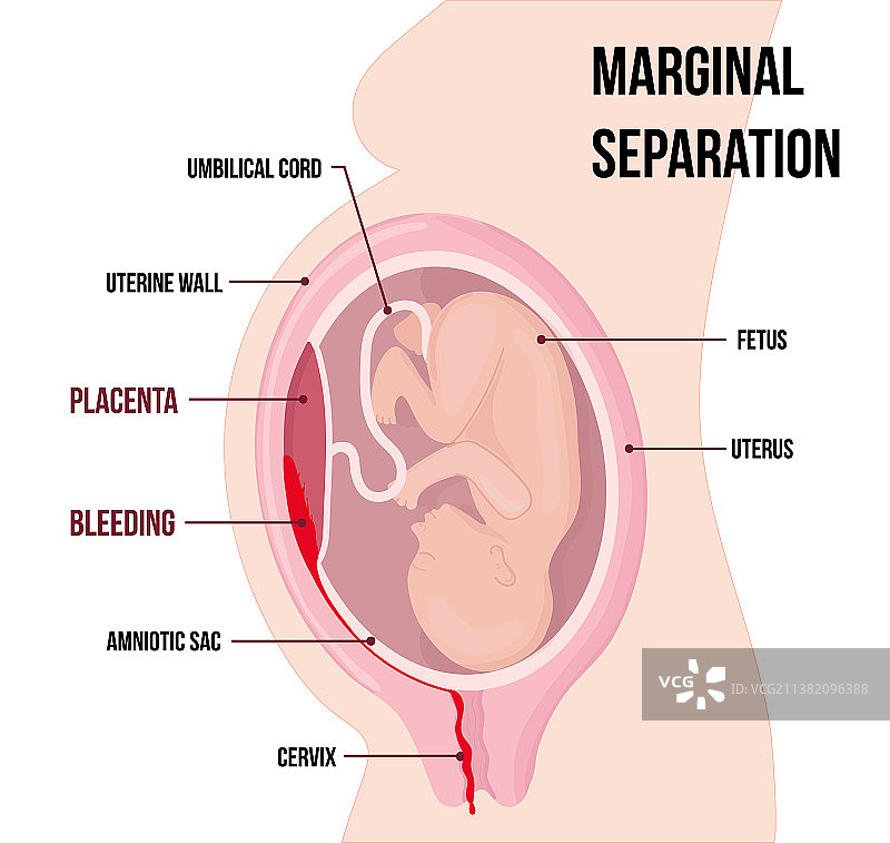 胎儿胎盘边缘性剥离图片素材